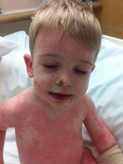 Racgp Kawasaki Disease The Importance Of Prompt Recognition And