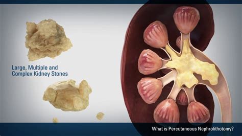 Percutaneous Nephrolithotomy Pcnl Youtube