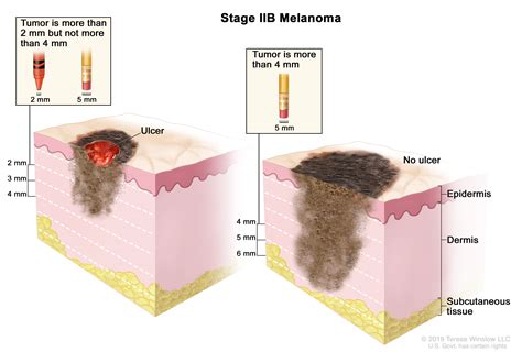 Malignant Melanoma Diagram