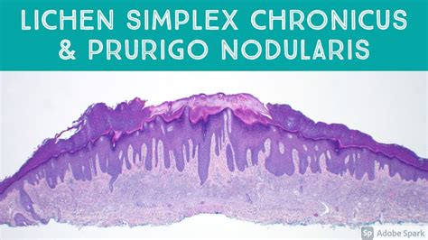 lichen simplex chronicus and prurigo nodularis the lichen every pathologist should know youtube