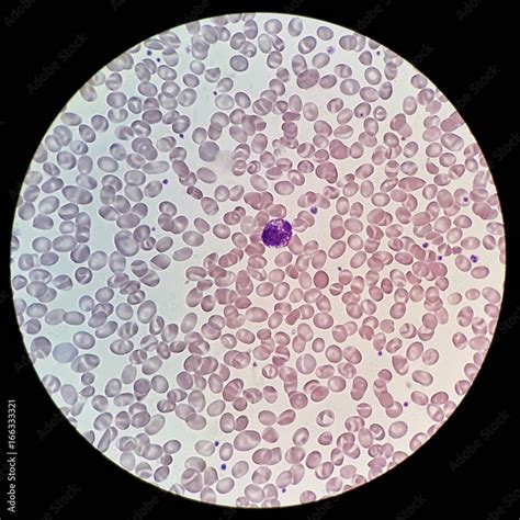 Human Blood Smear With Abnormal Red Blood Cells Morphology Call