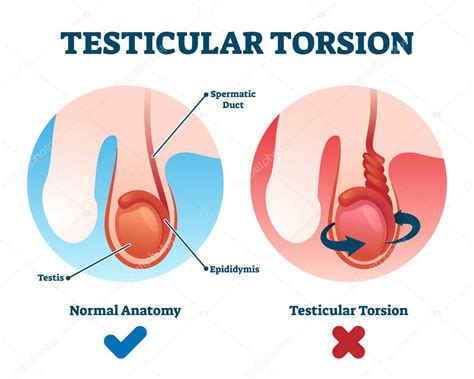 Ilustración del vector de torsión testicular Esquema de giro del