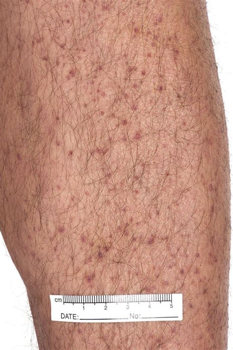 Racgp A Rare Cause Of Petechial Rash In The 21st Century
