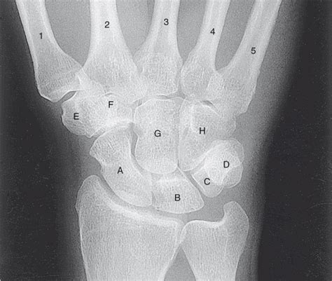 Diagram Pa Wrist Anatomy X Ray 2018 Diagram Quizlet