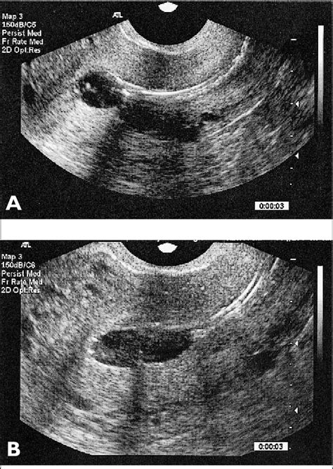 Sagittal Views Of A Normal Uterine Cavity On Sonohysterography Showing