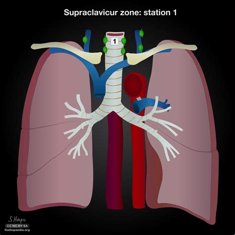 Thoracic Lymph Node Stations Illustrations Image