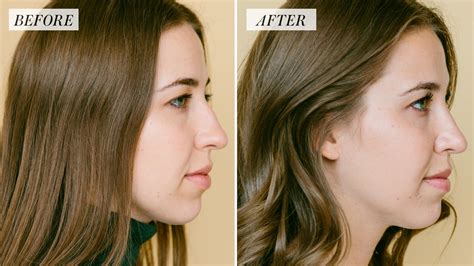 I Got Rhinoplasty At 25 — Heres What To Expect From A Nose Job