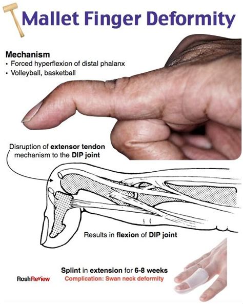 Mallet Finger Deformity Physical Therapy Medical Anatomy Emergency