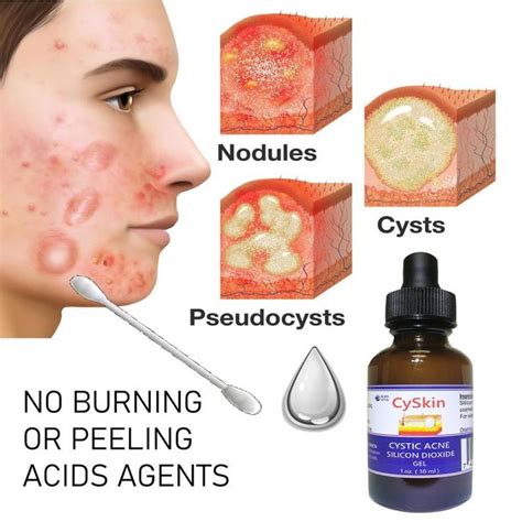 Cystic Acne Skin Treatment Cyskin Silicon Dioxide Gel Etsy Cystic