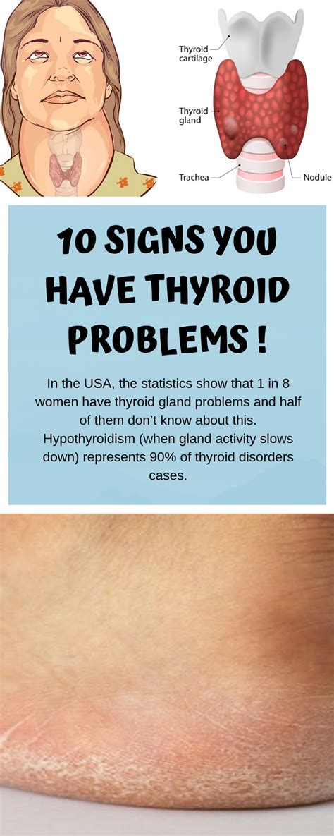 10 Signs You Have Thyroid Problems
