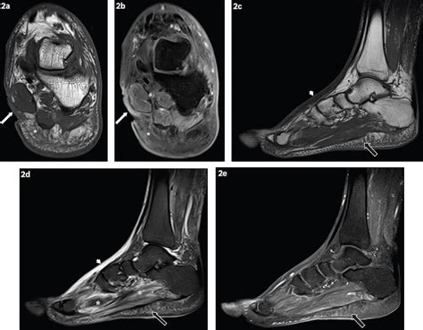 Magnetic Resonance Imaging Of Diabetic Foot Complications Smj