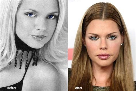 Sophie Monk Plasticsurgery Before And After Celebrity Plastic