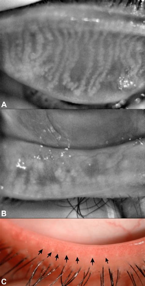 Meibomian Gland Loss Mgl Of The Upper And Lower Eyelids In A Patient Download Scientific