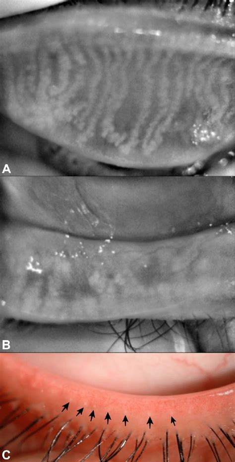 Meibomian Gland Loss MGL Of The Upper And Lower Eyelids In A Patient Download Scientific