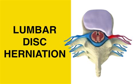 How Herniated Discs Cause Sciatic Nerve Pain — The Pain Free Institute