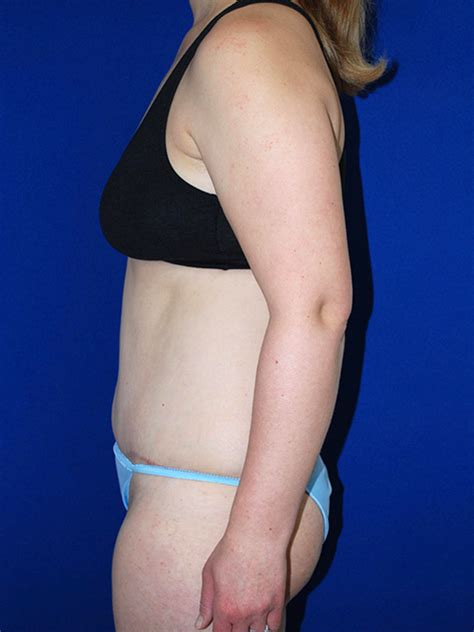 Extended Abdominoplasty Before And After Plastic Surgery Institute Of Washington