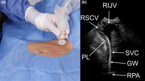 The Right Supraclavicular Fossa Ultrasound View For Correct Catheter