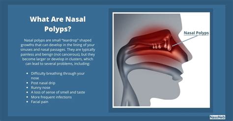 Nasal Polyps Causes Symptoms Treatments And Prevention Nasoneb®