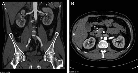 As each renal artery approaches the renal hilum, it divides into segmental arteries, which supply the renal parenchyma. (a) CTA on admission showing the right renal artery ...