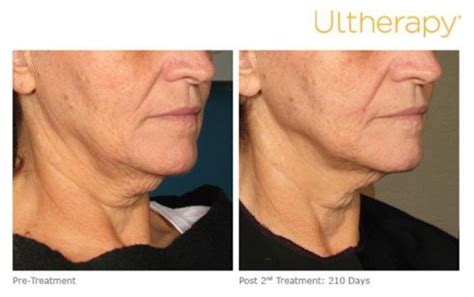 Ultherapy Before And After Photos Mulberry House Clinic Pandora Year Book