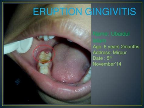 Eruption Gingivitis And Pericoronitis In Children