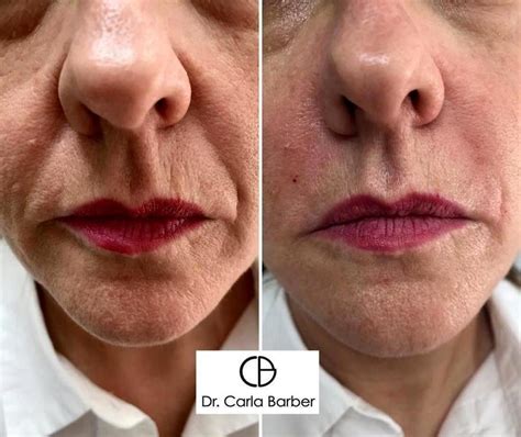Juvederm Nasolabial Folds Before And After
