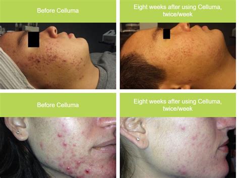 Celluma Acne Led Light Treatment Taylor Woods Skincare