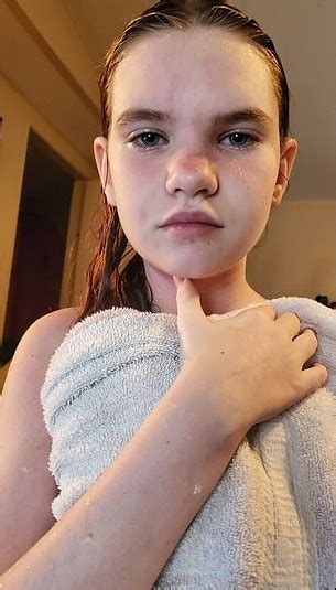 Esta Menina De 12 Anos é Tão Alérgica à água Que Até Um Banho Pode Ser