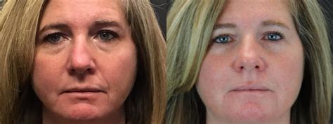 Dermal Fillers Before And After Photos Patient 184 Glen Carbon Il