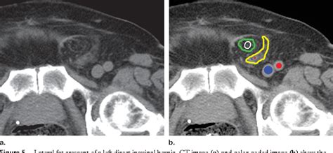 Figure 4 From Diagnosis Of Inguinal Region Hernias With Axial Ct The