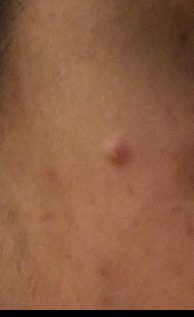 Pimple Like Bump On My Face Hasnt Gone Away In Months What Is It