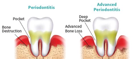 Gum Disease Information American Academy Of Periodontology