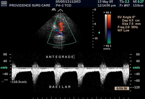 Transcranial Doppler Ultrasonography Of The Basilar Artery In Patients