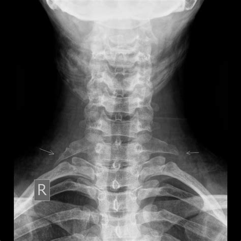 Opinions On Cervical Rib