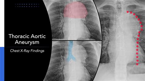 X Ray Images Of Aortic Tear