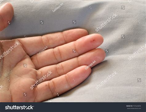 Womans Hand Bite Wound Centipede Stock Photo Edit Now 757626859