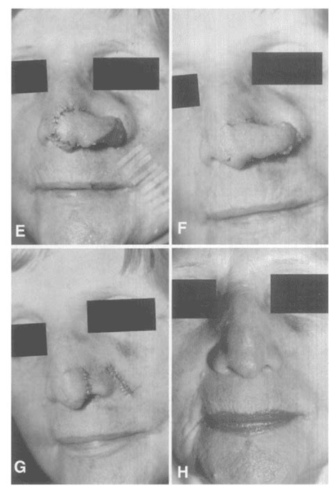 Figure 1 From Nasal Reconstruction With The Cheek Island Pedicle Flap