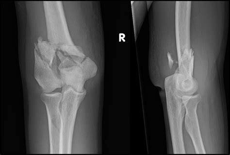 Intra Articular Distal Humerus Orif