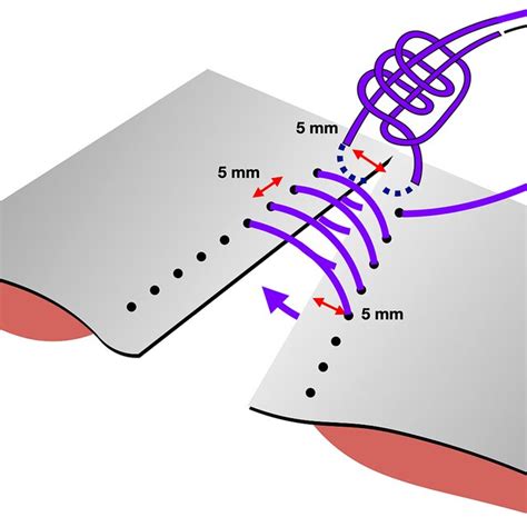 The Small Bite Aponeurotic Closure Technique Used In Midline Wounds