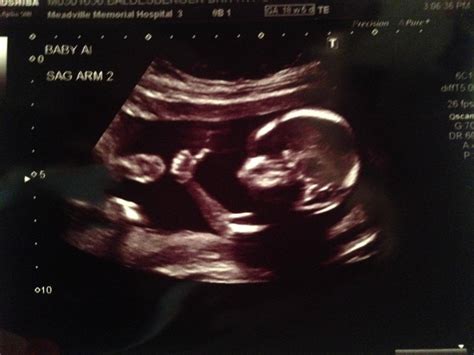 Baby Gives Thumbs Up In Amazing Ultrasound Image Information Nigeria