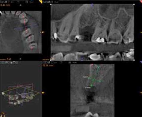 Imagerie cone beam ou tomographie volumique à faisceau conique