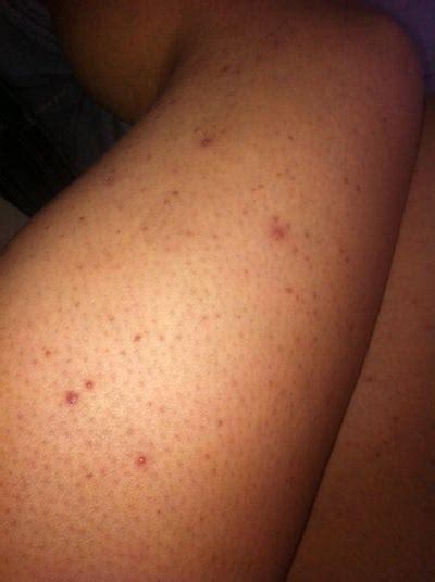 What Are The Dark Spots On My Legs Photo Doctor Answers Tips