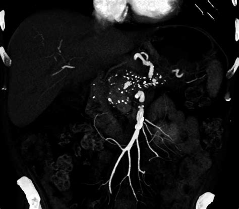 Chronic Pancreatitis With Pseudocyst Extends Into The Spleen Pancreas