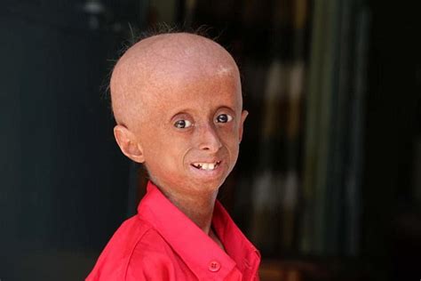 Group Of Progeria Kids