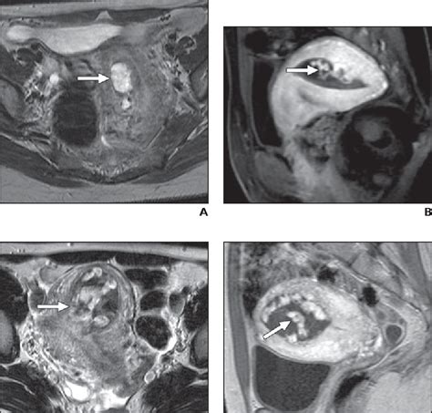 Figure 1—35 From Ct And Mri Of Early Intrauterine Pregnancy Semantic