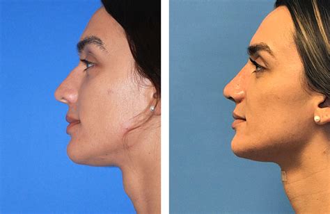 Facial Feminization Saigal Facial Plastic Surgery