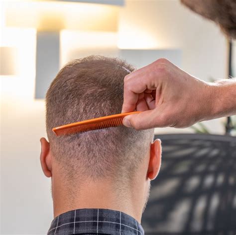 Maybe you would like to learn more about one of these? Haartransplantation in der Türkei | Erfahrung, Kosten ...