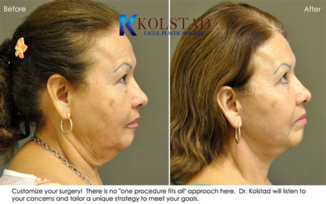 Facelift Before And After San Diego Dr Kolstad San Diego Facial