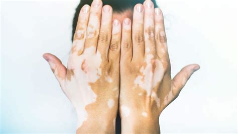 Vitiligo Skin Patches Diagnosis And Treatment Wellesley Ma