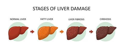 Stages Of Liver Damage Healthy Fatty Liver Fibrosis And Cirrhosis Stock
